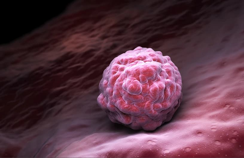 breast-cancer11