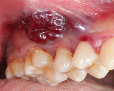 Cancer infected mouth