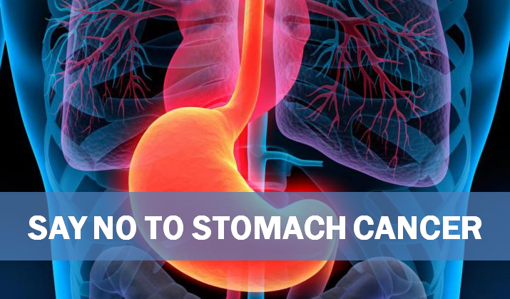 Stomach Cancer - An Overview
