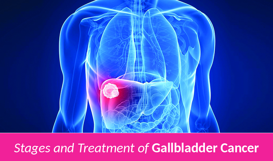 gallbladder cancer treatment