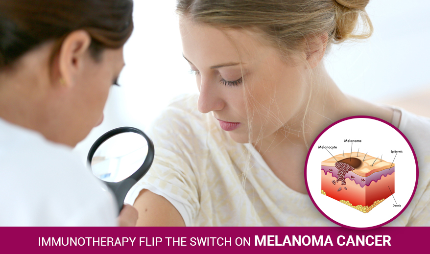 Immunotherapy Flip The Switch On Melanoma Cancer!